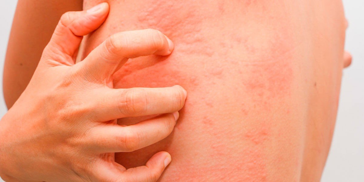 Allergy, Allergy, best allergy center in lahore, best allergy specialist in lahore